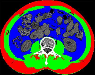 Prognostic value of cachexia index in patients with colorectal cancer: A retrospective study